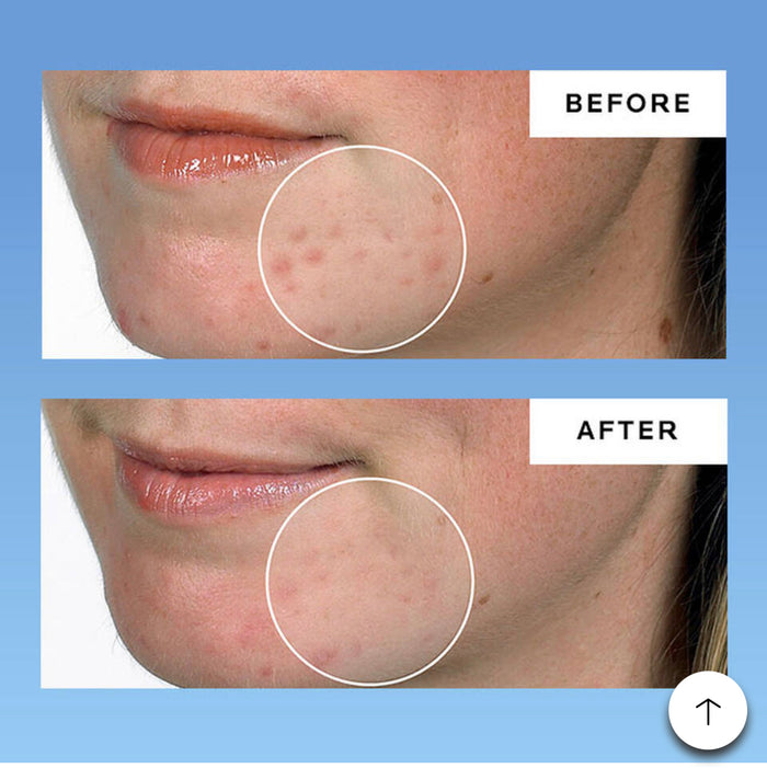 LA ROCHE POSAY Effaclar Dermatological Acne 3-Step System بكج معالج حب الشباب