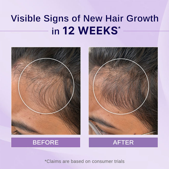 Rosemary & Hibiscus Hair Growth Oil With Redensyl, Biotin, Bhringraj & Aloe Vera - 100 ml | Pack of 2