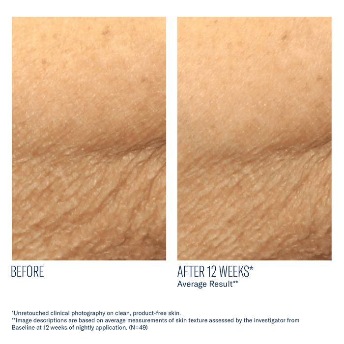 Before and after skin texture comparison showing smoother skin after 12 weeks of AlphaRet Body Overnight Cream