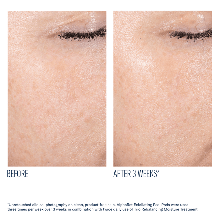 Before and after 3 weeks of skinbetter AlphaRet Exfoliating Peel Pads on cheek skin