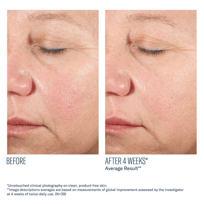 Before and after facial skin comparison showing reduced redness and improved texture after 4 weeks