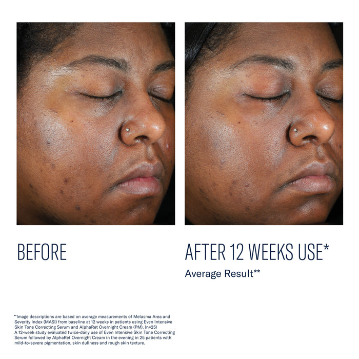 Before and after 12 weeks use of skinbetter Even Intensive Skin Tone Correcting Serum, showing reduced dark marks
