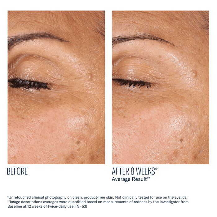 Before and after eye area close-up showing reduced dryness and fine lines after 8 weeks